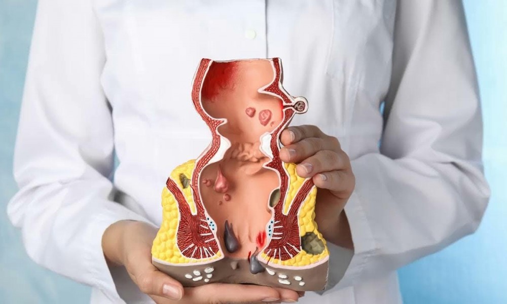 Bilecik'te Hemoroid Tedavisi