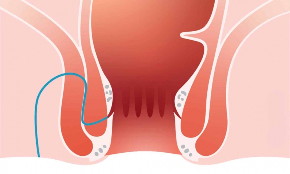 Rektovajinal Fistül